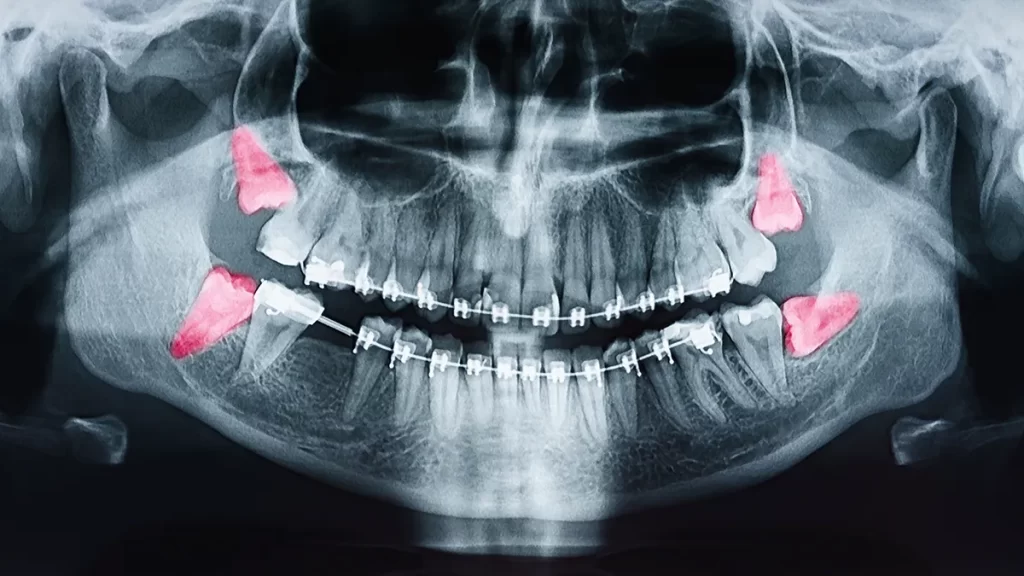 Full mouth x-ray with wisdom teeth highlighted in pink.